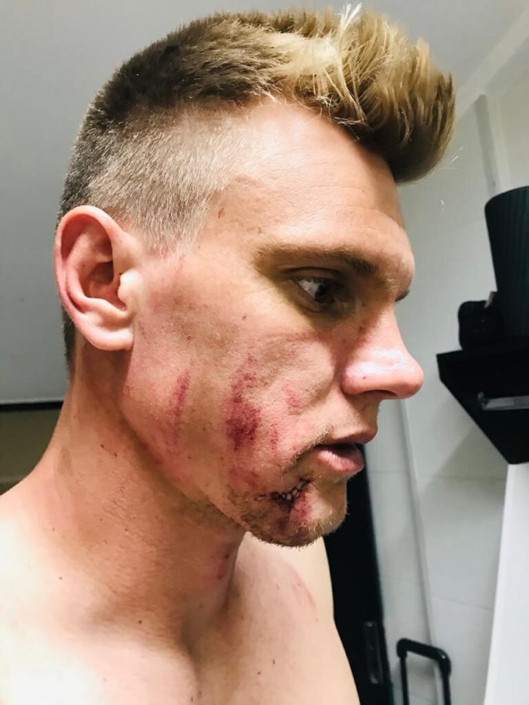 試合中にgkが足の裏キックを顔面にくらい5針を縫う大ケガ バモスアオブラジル3 試合中にgkが足の裏キックを顔面にくらい5針を縫う大ケガ バモスアオブラジル3